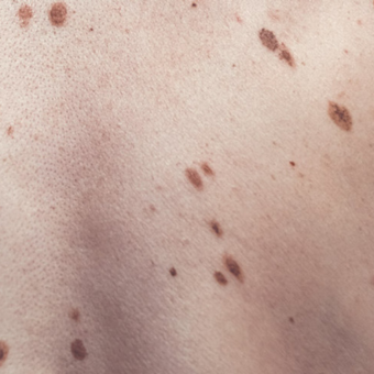 Dysplastic nevi