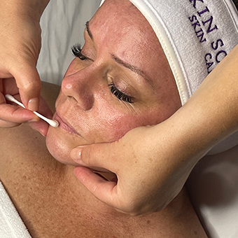 Lip treatment