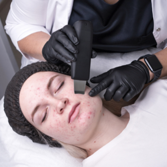 Acne treatment